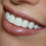 Циркониевые коронки: преимущества